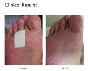 CamWell Clinical Results - Foot